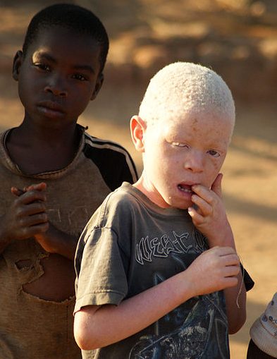 Albínský chlapec v africkém Malawi.