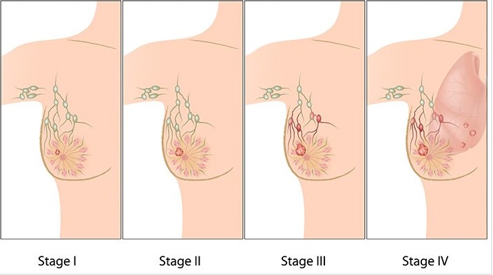 Rakovina prsu se dělí do čtyř stádií, od třetího pronikají do těla metastáze a zákeřnou nemoc již není vůbec snadné zastavit.