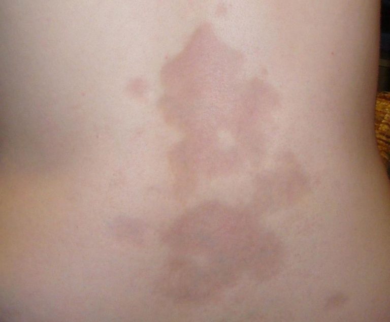 Lokalizovaná kožní forma onemocnění se označuje jako morfea.