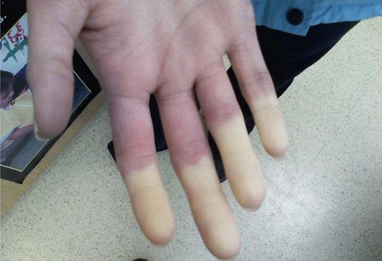 U podstatné části pacientů předchází vážným změnám na kůži projevy Raynaudova fenoménu. Prsty jsou postiženy bílými skvrnami.