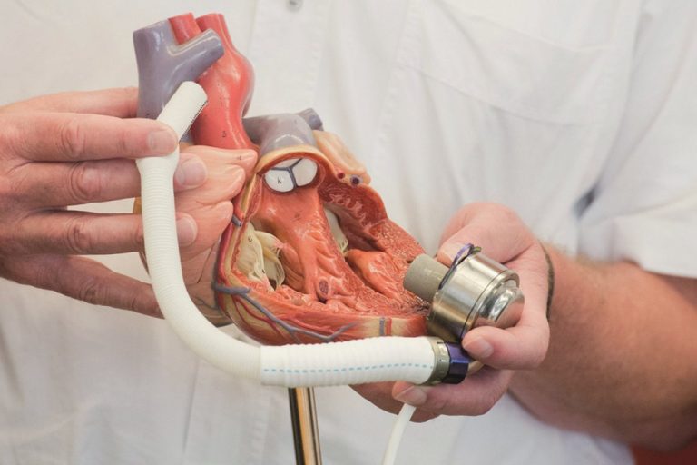 Nová technologie v podobě voperované srdeční pumpy by mohla zachraňovat ročně stovky lidí.
