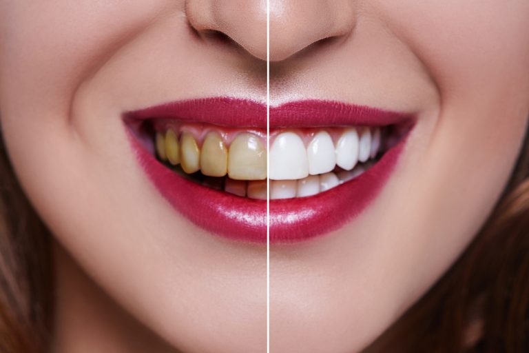 Obroušení před aplikací fazety je nevratný zásah do celistvosti zubu. Už jen kvůli tomu je nutné dobře uvážit, kdy je fazeta skutečně výhodná a kdy zbytečná.
