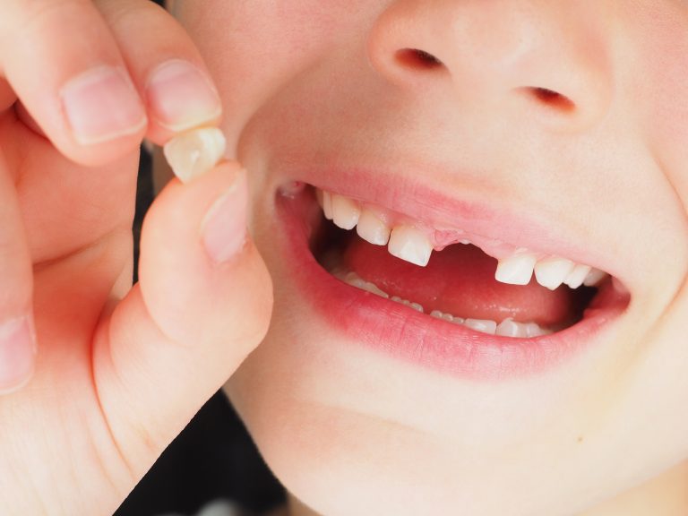 Péče o mléčné zuby je tedy důležitá pro to, aby nám co nejdéle vydržely zuby stálé.