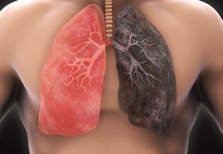 Zhruba v 90 % případů jde o karcinom plic neboli bronchogenní karcinom, u nemocných se v plicích objevují také metastáze.