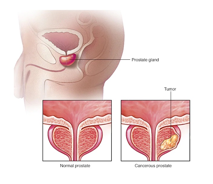 V první fázi je rakovina prostaty asymptomatická, tedy bez příznaků, a je tak většinou odhalena zcela náhodou. Paradoxně uzdravení závisí na včasném odhalení a započetí správné léčby.