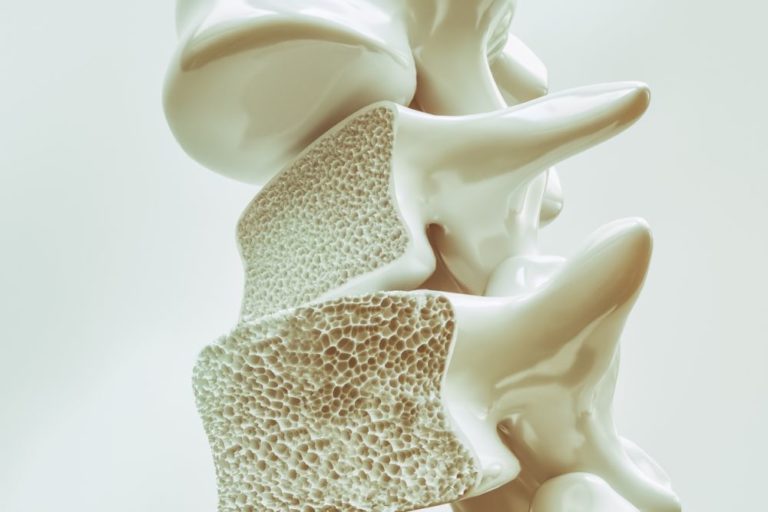 Osteoporóza je onemocnění, při kterém ubývá kostní hmota a dochází ke změnám v její struktuře. Kosti postupně ztrácejí vápník, jenž zajišťuje jejich tvrdost, proto jsou křehčí a snadno se zlomí.