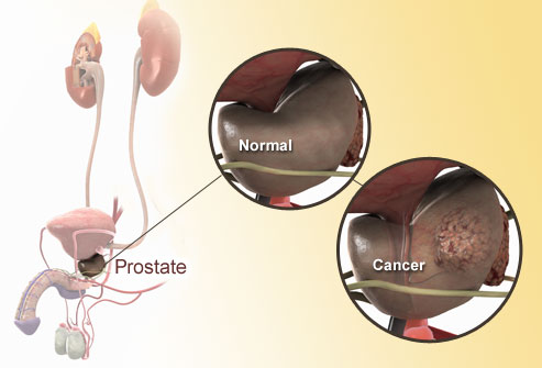 Rakovina prostaty nejčastěji postihuje muže ve věku 65 až 79 let, objevit se ale může i u čtyřicátníka.