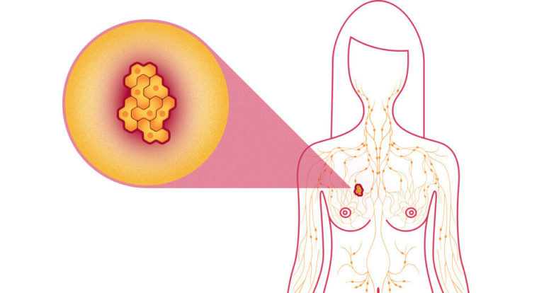 Příčiny vzniku karcinomu prsu zatím nejsou přesně známé.