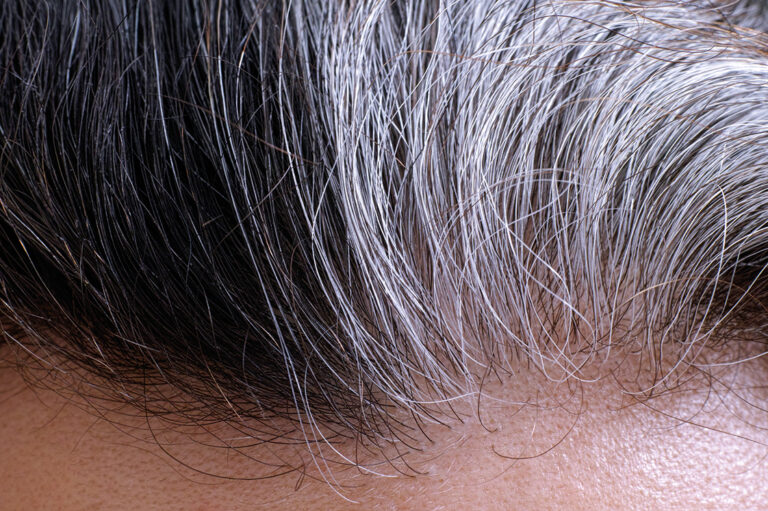 V některých případech mohou ke ztrátě pigmentu ve vlasech přispět genetické mutace či změny v imunitním systému.