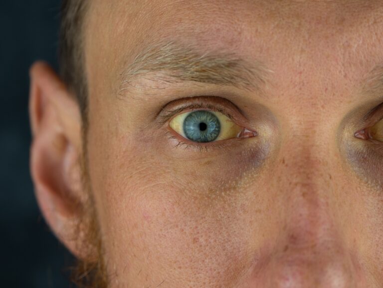 Gilbertův syndrom se projevuje občasným zežloutnutím očního bělma nebo kůže.