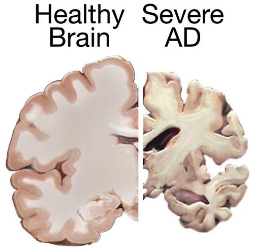 Srovnání průřezu zdravým mozkem (vlevo) a mozkem v pozdní fázi Alzheimerovy choroby. FOTO: National Institutes of Health / Creative Commons / volné dílo