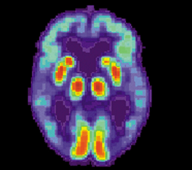 Z pozitronové emisní tomografie je patrná ztráta funkce spánkového laloku u pacientů trpících touto chorobou. FOTO: US National Institute on Aging, Alzheimer's Disease Education and Referral Center / Creative Commons / volné dílo