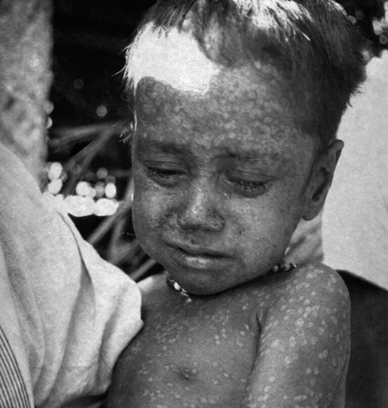 Tříletý chlapec z Bangladéše byl poslední osobou, která se nakazila přirozeně se vyskytujícím virem pravých neštovic, rok 1975. FOTO: CDC/ World Health Organization Stanley O. Foster M.D., M.P.H. / Creative Commons / volné dílo