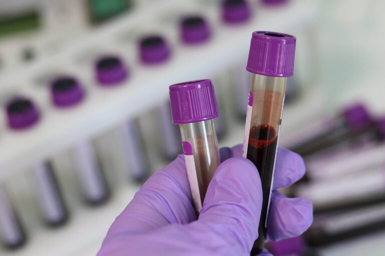 Zkumavka s krví pro CRP test k rozpoznání virové nebo bakteriální infekce. Foto: Shutterstock