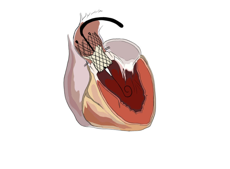 Ideálním pacientem je muž či žena nad 70 let, které trápí aortální stenóza. Foto: Nemocnice na Homolce
